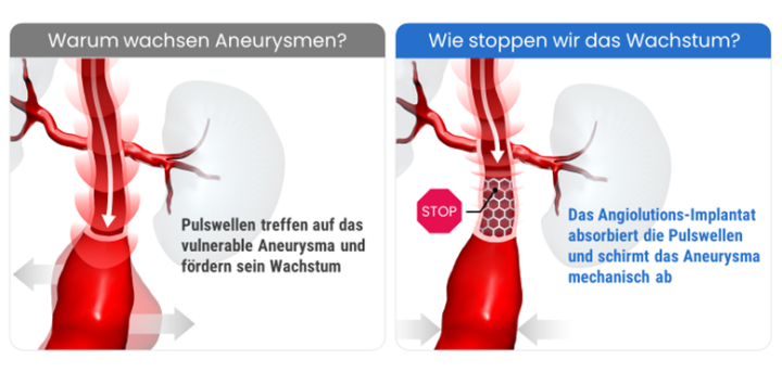 Angiolutions innovatives Gefäßimplantat schirmt das Aneurysma mechanisch von schädigenden Pulswellen der Aorta ab und verhindert damit ein weiteres Wachstum.